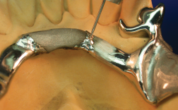 repair of broken sublingual bar